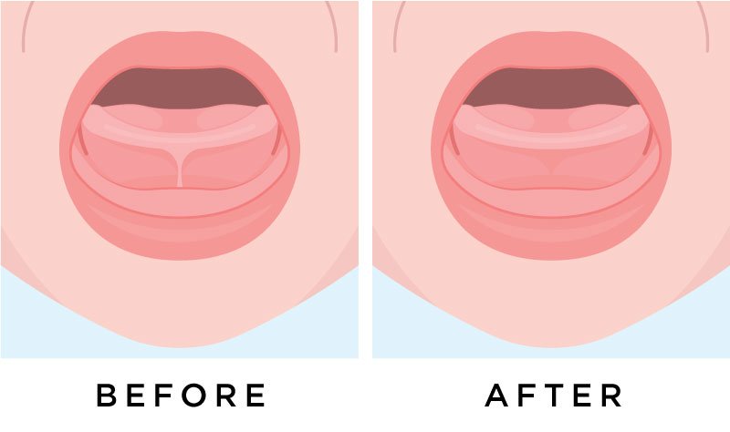 Frenectomy Sammamish